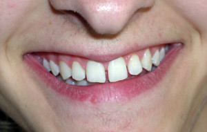 Diastema mediale und laterale