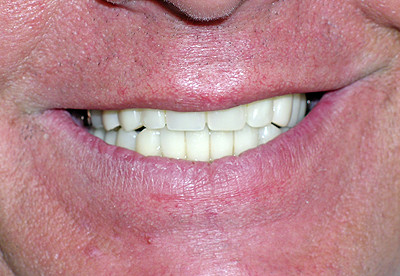 Beide Sorten von Implantaten (geschraubt und zementiert) bringen wieder ein schönes Lächeln und festen Biss.