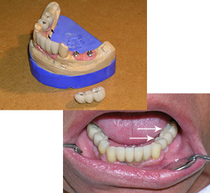 Damit Schraublöcher im Mund nicht sichtbar sind, werden sie mit zahnfarbenem Kunststoff verschlossen.