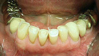 Durch Knirschen stark abgenutzte Schneidezähne, das Dentin liegt bereits weitläufig frei