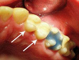 Zwei Zähne mit Kunststofffüllungen (Pfeile), daneben in Blau eine Aufbaufüllung aus Kunststoff