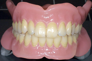 Totalprothese